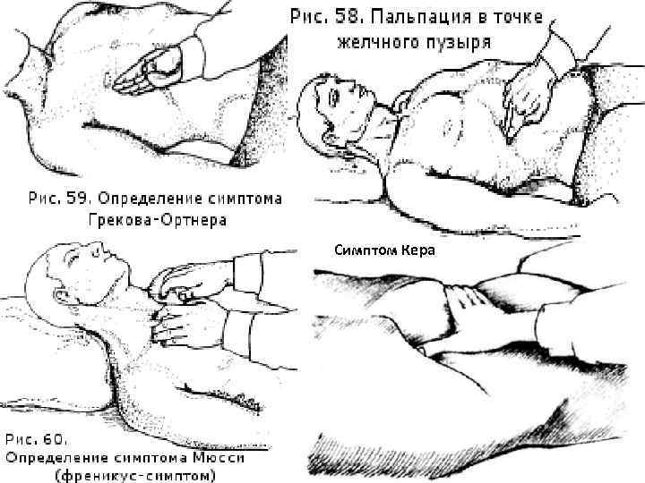 Симптом Кера 