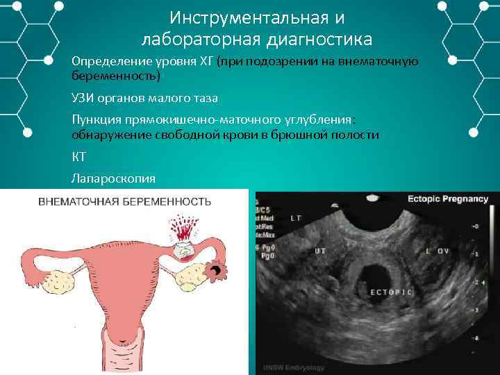 Инструментальная и лабораторная диагностика Определение уровня ХГ (при подозрении на внематочную беременность) УЗИ органов