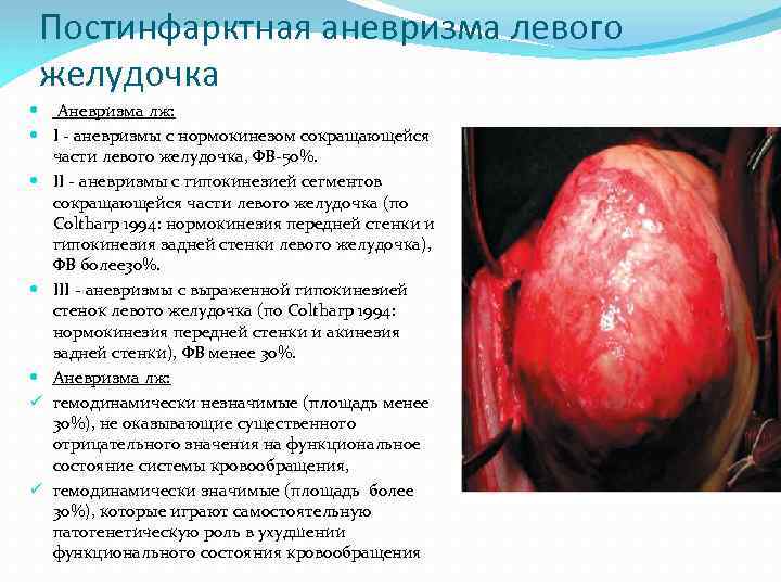 Постинфарктная аневризма левого желудочка Аневризма лж: I - аневризмы c нормокинезом сокращающейся части левого
