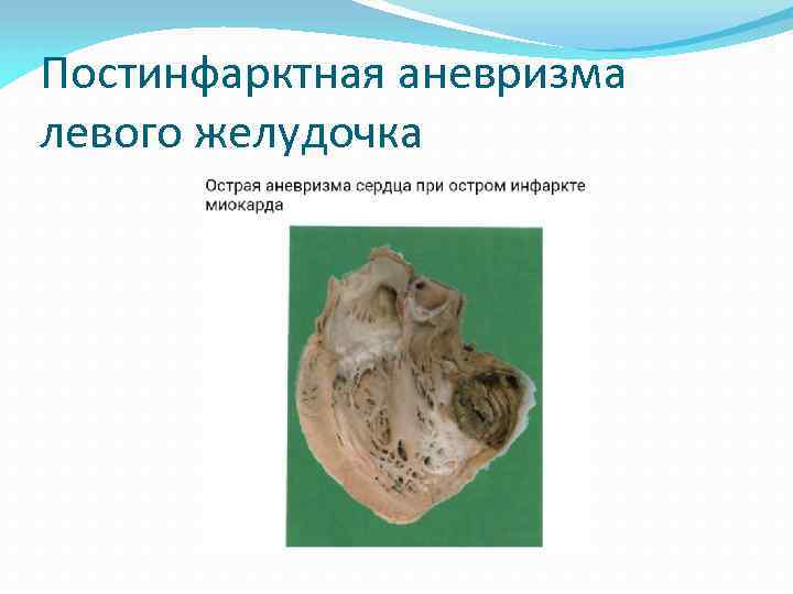 Постинфарктная аневризма левого желудочка 