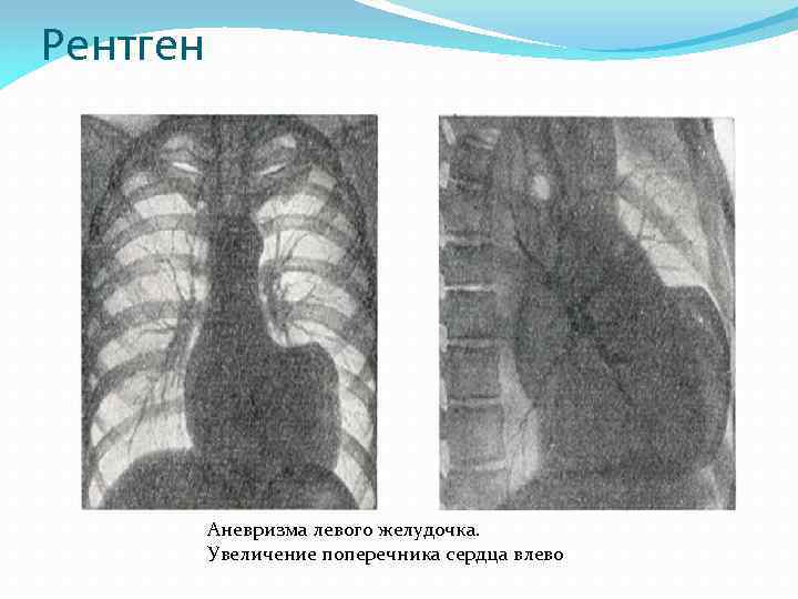 Рентген Аневризма левого желудочка. Увеличение поперечника сердца влево 