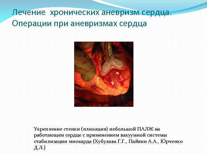 Лечение хронических аневризм сердца. Операции при аневризмах сердца Укрепление стенки (пликация) небольшой ПАЛЖ на