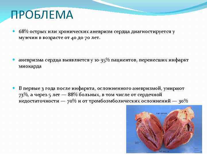 ПРОБЛЕМА 68% острых или хронических аневризм сердца диагностируется у мужчин в возрасте от 40