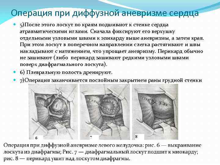 Операция при диффузной аневризме сердца 5)После этого лоскут по краям подшивают к стенке сердца