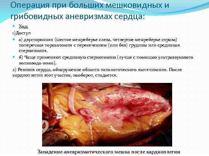 Операция при больших мешковидных и грибовидных аневризмах сердца: Ход: 1)Доступ а) двусторонняя (шестое межреберье