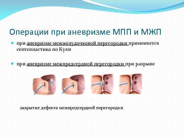 Операции при аневризме МПП и МЖП при аневризме межжелудочковой перегородки применяется септопластика по Кули