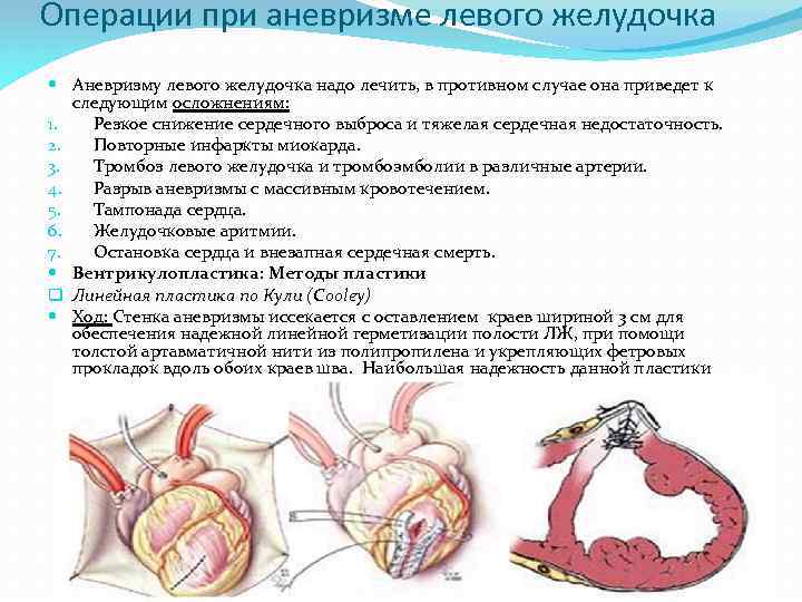 Операции при аневризме левого желудочка Аневризму левого желудочка надо лечить, в противном случае она