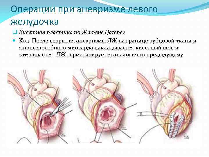 Операции при аневризме левого желудочка q Кисетная пластика по Жатене (Jatene) Ход: После вскрытия