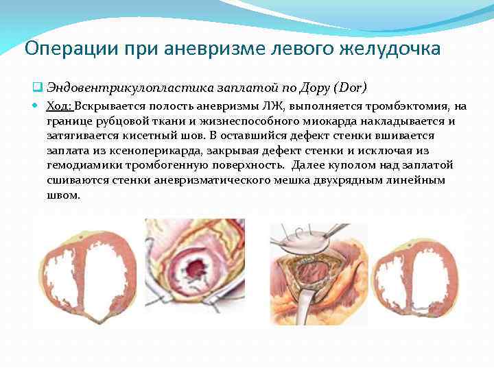 Операции при аневризме левого желудочка q Эндовентрикулопластика заплатой по Дору (Dor) Ход: Вскрывается полость