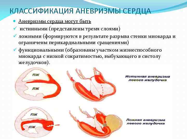 КЛАССИФИКАЦИЯ АНЕВРИЗМЫ СЕРДЦА Аневризмы сердца могут быть ü истинными (представлены тремя слоями) ü ложными