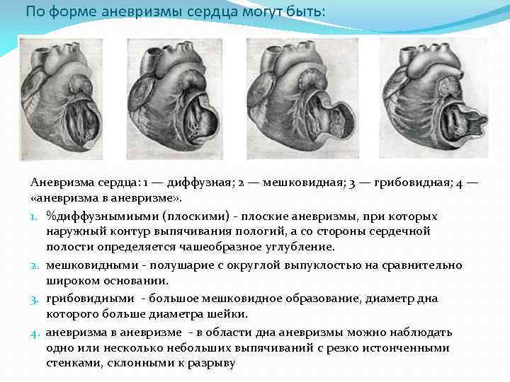 По форме аневризмы сердца могут быть: Аневризма сердца: 1 — диффузная; 2 — мешковидная;