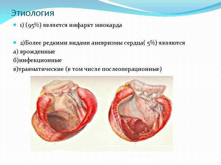 Этиология 1) (95%) является инфаркт миокарда 2)Более редкими видами аневризмы сердца( 5%) являются а)