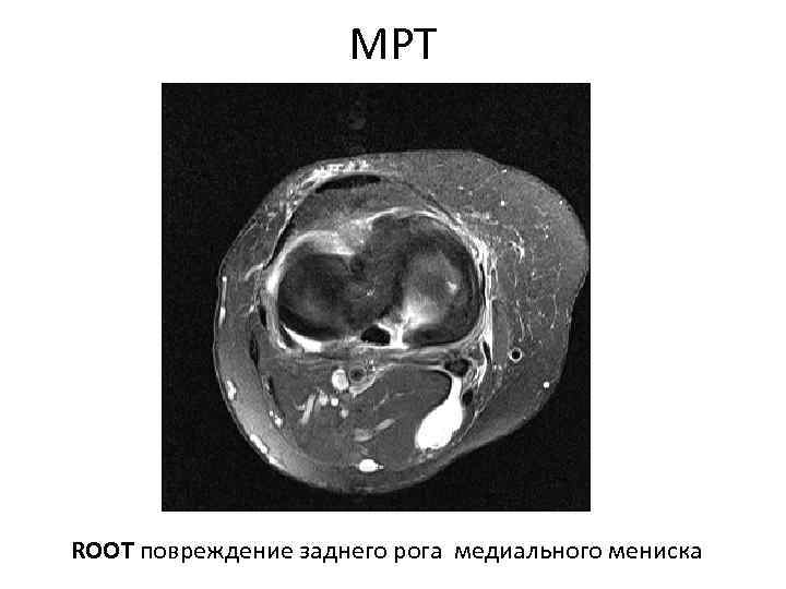 МРТ ROOT повреждение заднего рога медиального мениска 