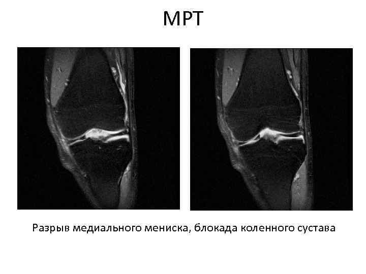 МРТ Разрыв медиального мениска, блокада коленного сустава 