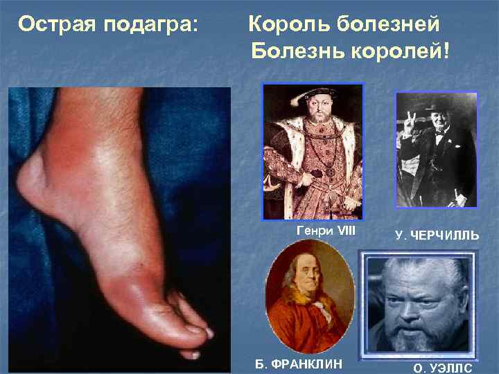 Острая подагра: Король болезней Болезнь королей! Генри VIII Б. ФРАНКЛИН У. ЧЕРЧИЛЛЬ О. УЭЛЛС