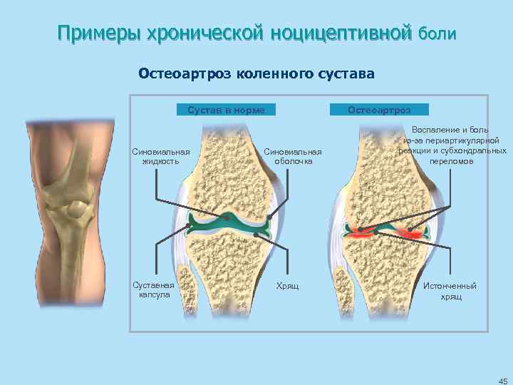 Примеры хронической ноцицептивной боли Остеоартроз коленного сустава Сустав в норме Синовиальная жидкость Суставная капсула