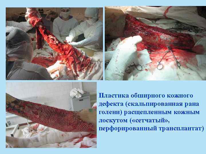 Пластика обширного кожного дефекта (скальпированная рана голени) расщепленным кожным лоскутом ( «сетчатый» , перфорированный
