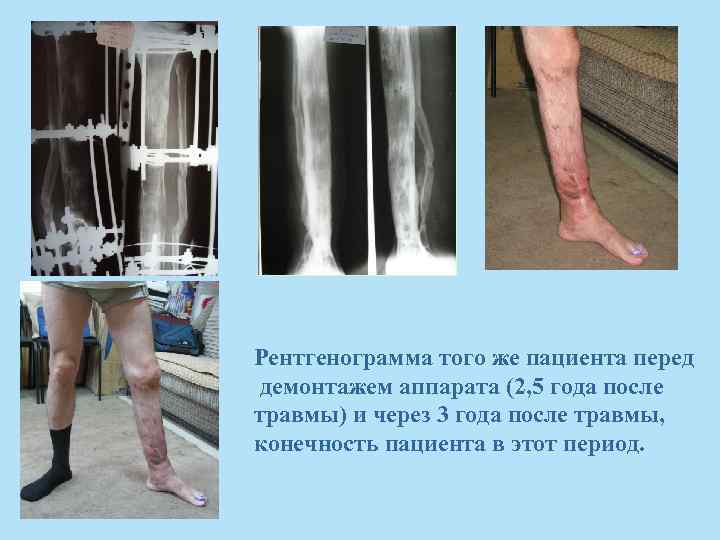 Рентгенограмма того же пациента перед демонтажем аппарата (2, 5 года после травмы) и через