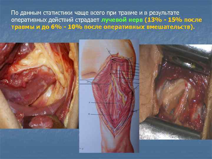 По данным статистики чаще всего при травме и в результате оперативных действий страдает лучевой