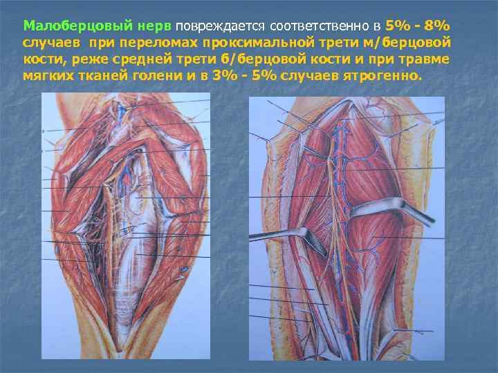 Малоберцовый нерв повреждается соответственно в 5% - 8% случаев при переломах проксимальной трети м/берцовой