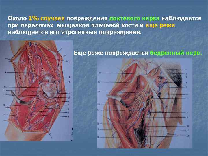 Около 1% случаев повреждения локтевого нерва наблюдается при переломах мыщелков плечевой кости и еще