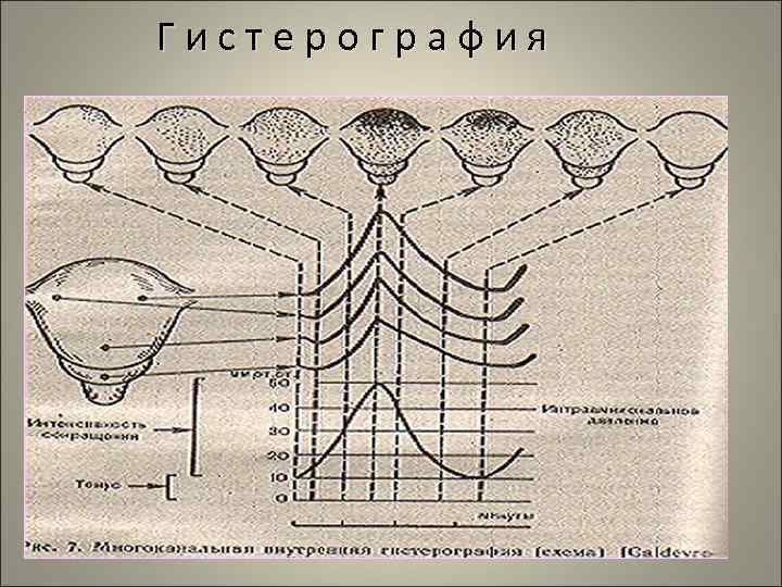 Гистерография 