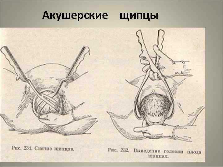 Акушерские щипцы 