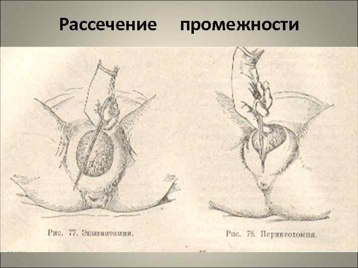 Рассечение промежности 