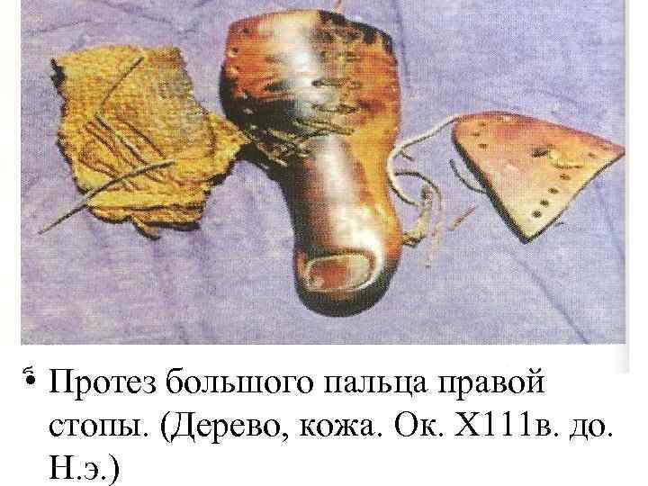  • Протез большого пальца правой стопы. (Дерево, кожа. Ок. Х 111 в. до.