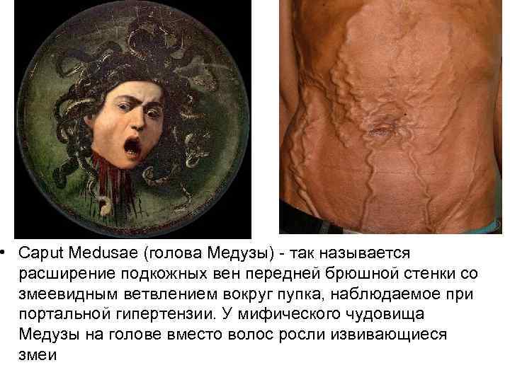  • Caput Medusae (голова Медузы) так называется расширение подкожных вен передней брюшной стенки