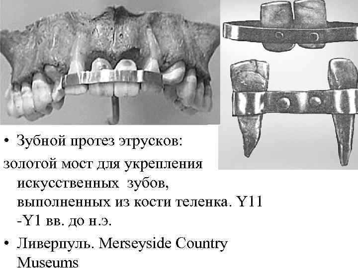  • Зубной протез этрусков: золотой мост для укрепления искусственных зубов, выполненных из кости