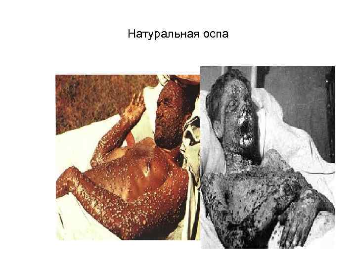 Натуральная оспа 