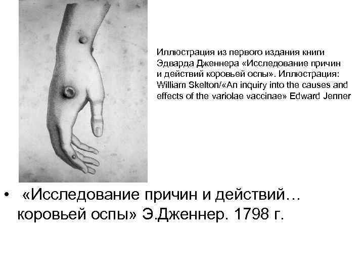 Иллюстрация из первого издания книги Эдварда Дженнера «Исследование причин и действий коровьей оспы» .