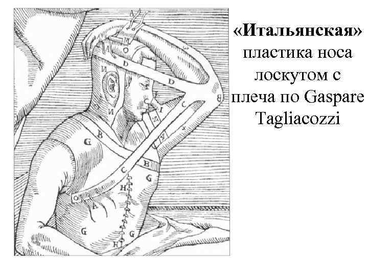  «Итальянская» пластика носа лоскутом с плеча по Gaspare Tagliacozzi 
