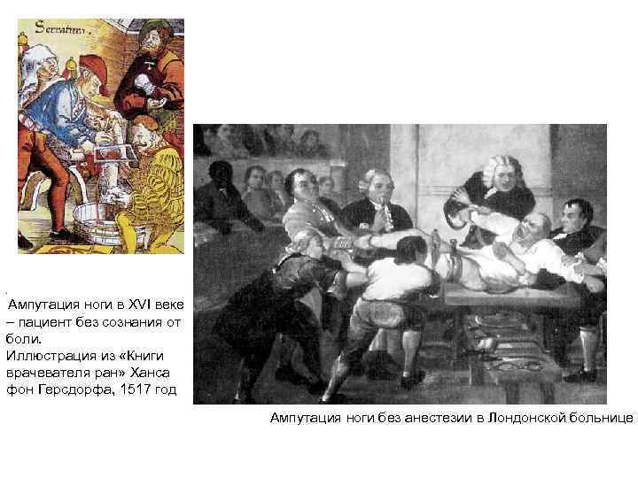 . Ампутация ноги в XVI веке – пациент без сознания от боли. Иллюстрация из