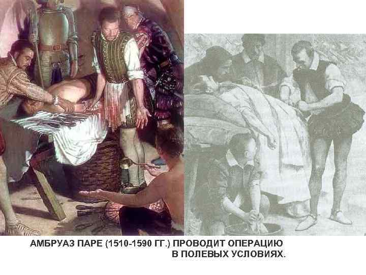 АМБРУАЗ ПАРЕ (1510 -1590 ГГ. ) ПРОВОДИТ ОПЕРАЦИЮ В ПОЛЕВЫХ УСЛОВИЯХ. 