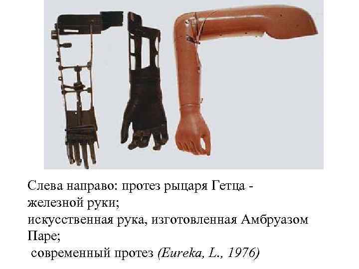 Слева направо: протез рыцаря Гетца железной руки; искусственная рука, изготовленная Амбруазом Паре; современный протез