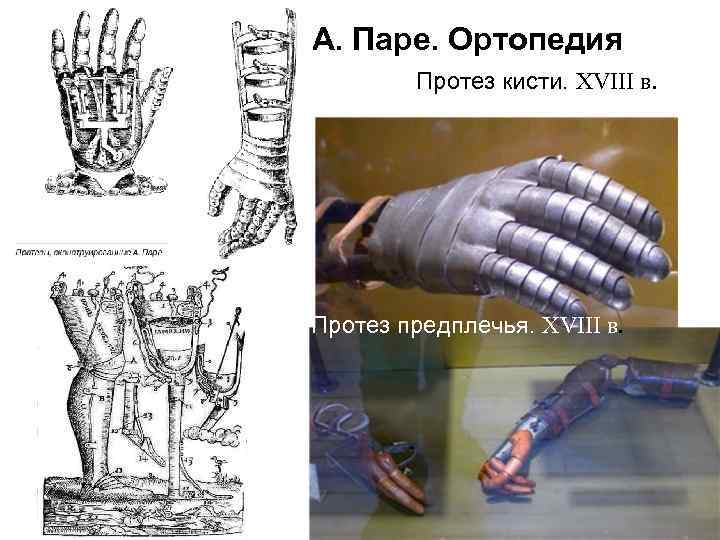 А. Паре. Ортопедия Протез кисти. XVIII в. Протез предплечья. XVIII в. 