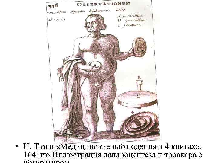  • Н. Тюлп «Медицинские наблюдения в 4 книгах» . 1641 гю Иллюстрация лапароцентеза