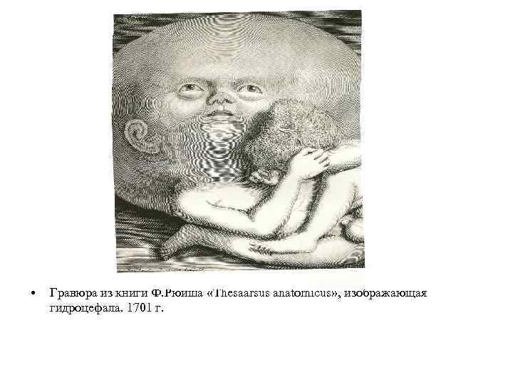  • Гравюра из книги Ф. Рюиша «Thesaarsus anatomicus» , изображающая гидроцефала. 1701 г.