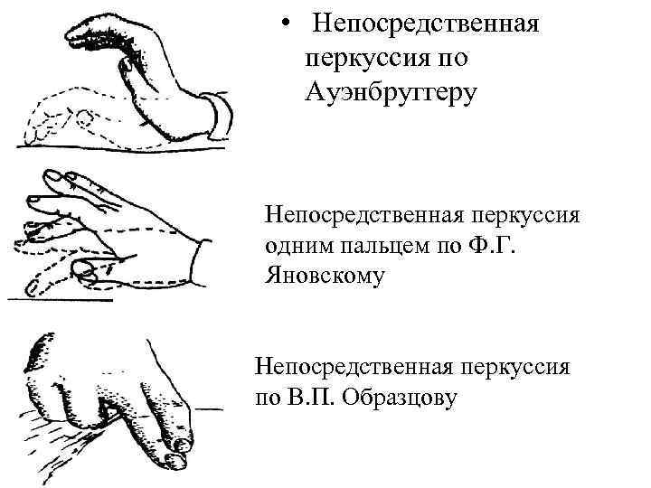  • Непосредственная перкуссия по Ауэнбруггеру Непосредственная перкуссия одним пальцем по Ф. Г. Яновскому