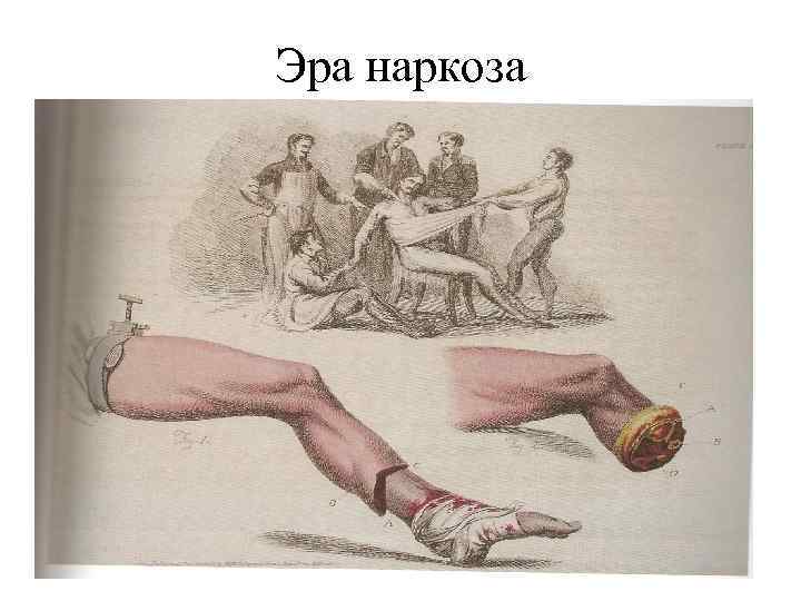 Эра наркоза 