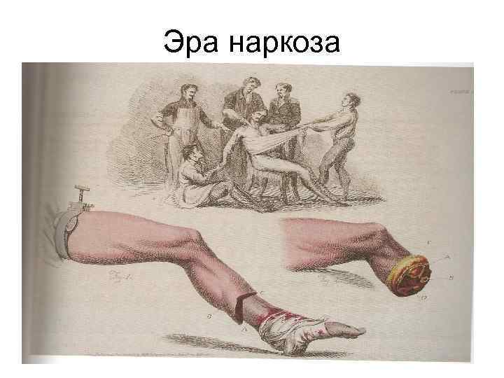 Эра наркоза 