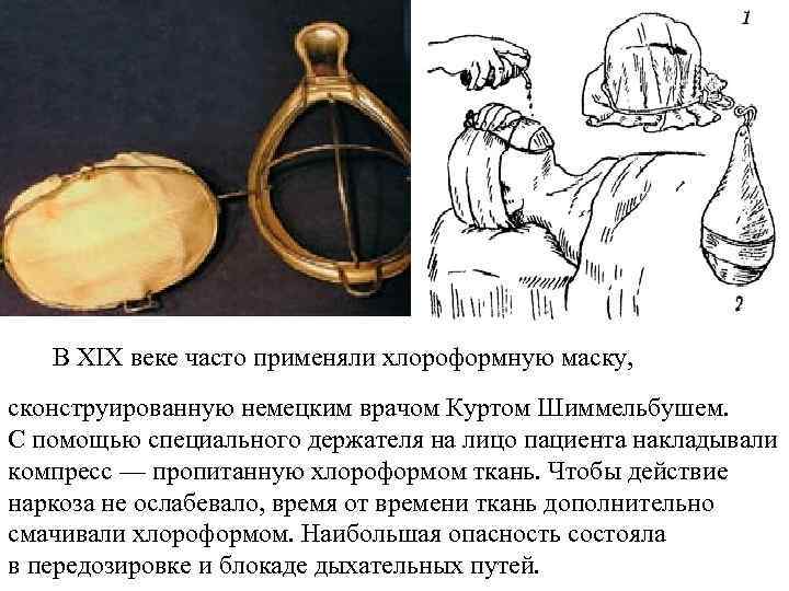  В XIX веке часто применяли хлороформную маску, сконструированную немецким врачом Куртом Шиммельбушем. С