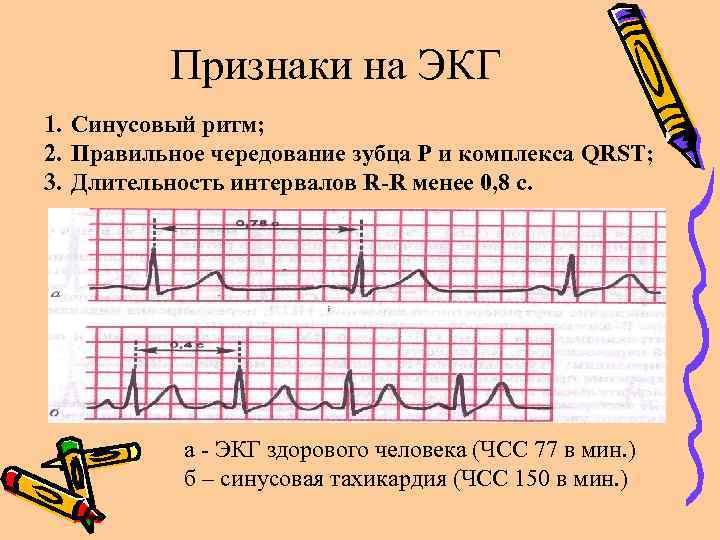 Компьютерное заключение синусовый ритм что это