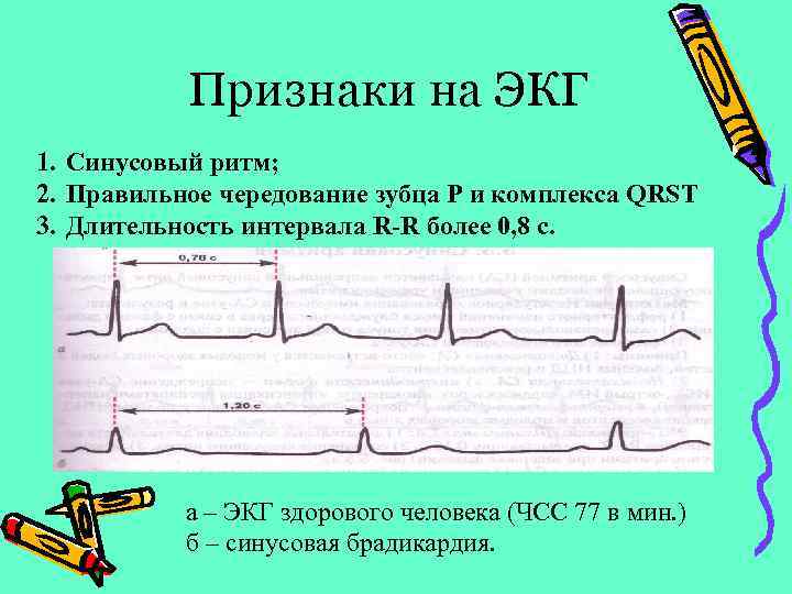 Аритмия на фоне невроза