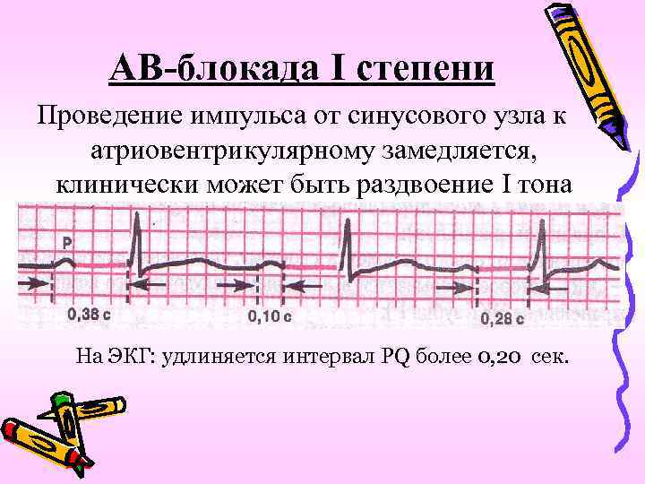 Ав блокада сердца 1 степени