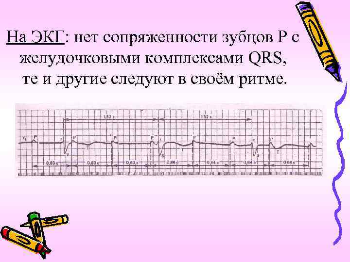 На ЭКГ: нет сопряженности зубцов Р с желудочковыми комплексами QRS, те и другие следуют