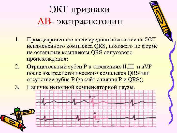 Экстрасистолы экг фото