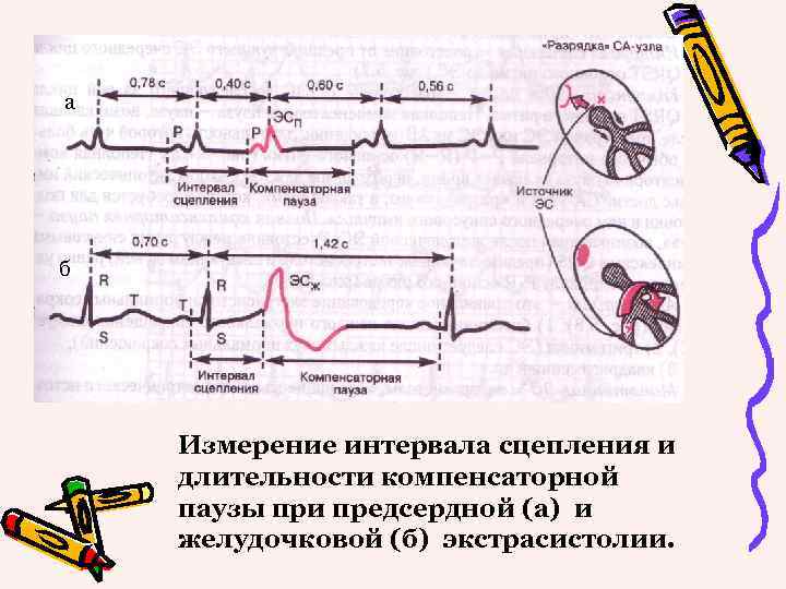 Компенсаторная экстрасистола. Неполная компенсаторная пауза на ЭКГ. Интервал сцепления экстрасистолы на ЭКГ. Желудочковая экстрасистолия интервал сцепления. Желудочковая экстрасистола компенсаторная пауза.